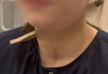 Ростовские хирурги спасли девочку, через шею которой прошла 14-сантиметровая ветка